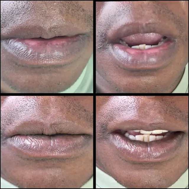 Lips before and after lip neutralisation on a client with deep skin