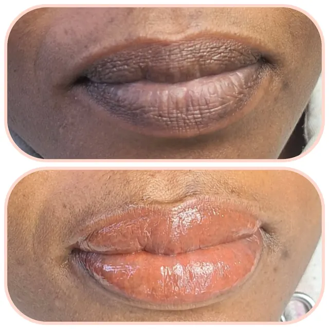 Lips before and after the first lip neutralisation session