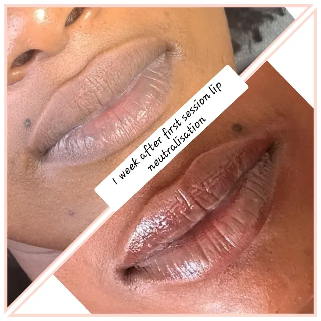 Lip neutralisation one week after the first session