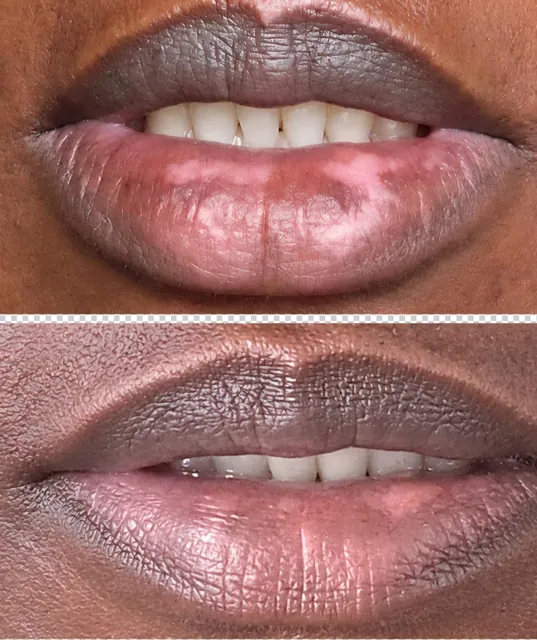 Smile before and after lip neutralisation on a client with deep skin